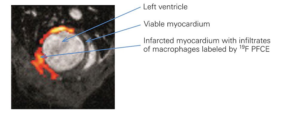 Combined 19F and 1H MRI of a rat heart with anterior myocardial infarct. The 19F nanoemulsion ingested by the macrophages is visible in the infarct region. Courtesy of Yuxiang Ye.