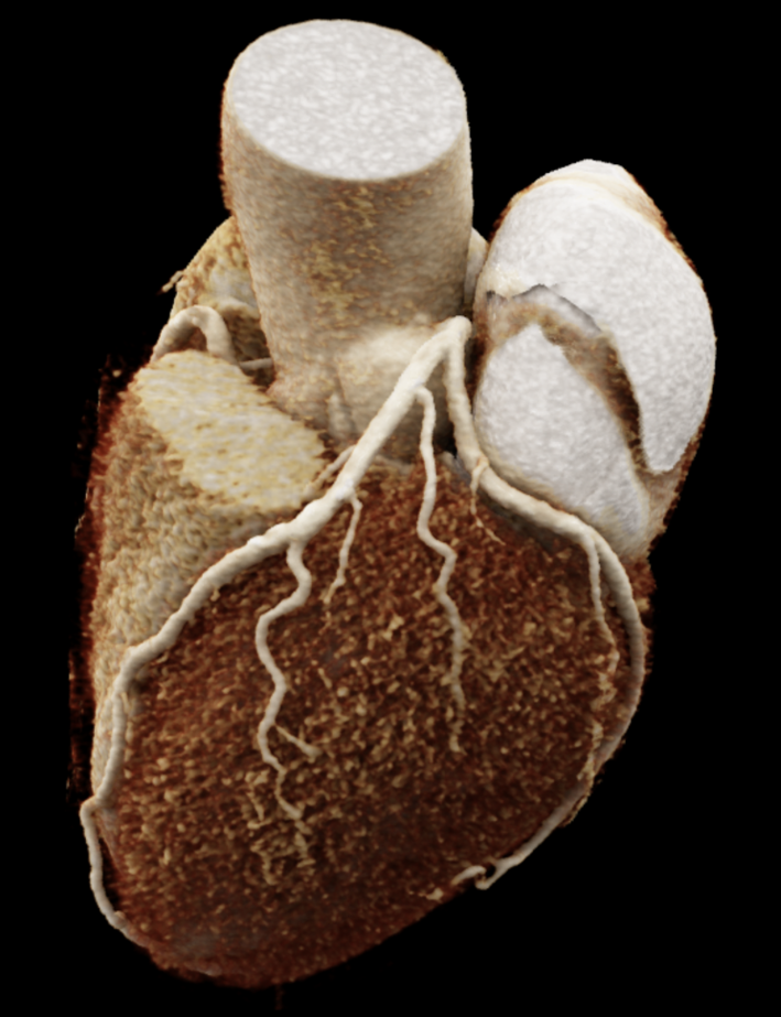 Cardio CT Das Bild zeigt eine CT-Aufnahme des Herzens und der Herzkranzgefäße