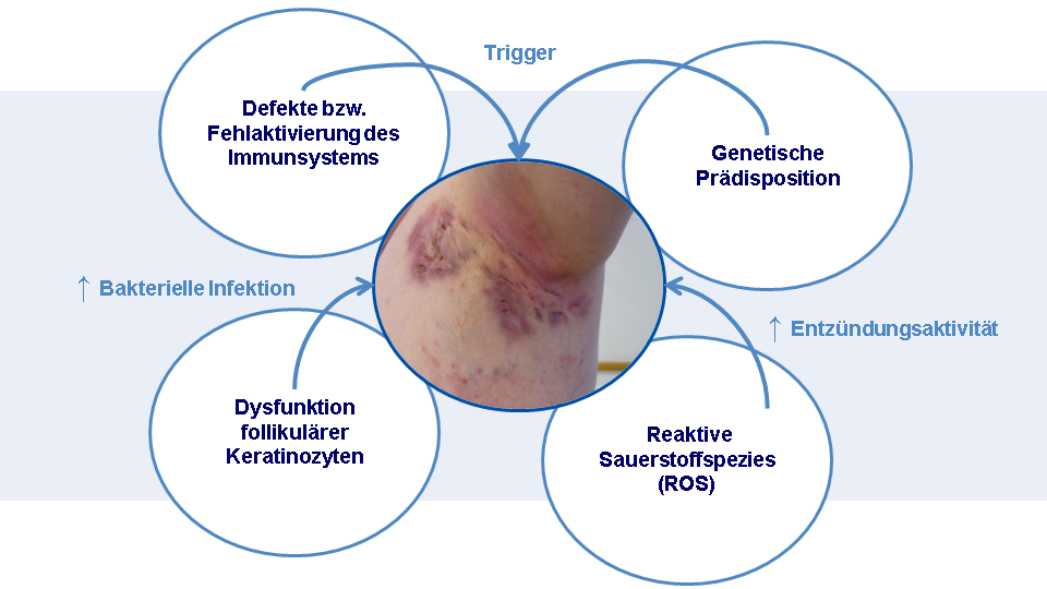 Bekannte pathogenetische Einflussfaktoren bei Acne inversa. Schaubild der bekannten pathogenetischen Einflussfaktoren bei Acne inversa.