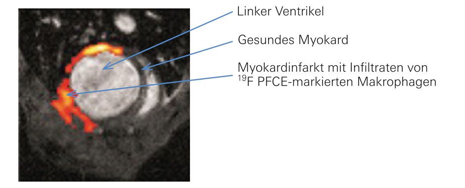 Kombinierte 19F- und 1H-MRT eines Rattenherzens mit anteriorem Myokardinfarkt.