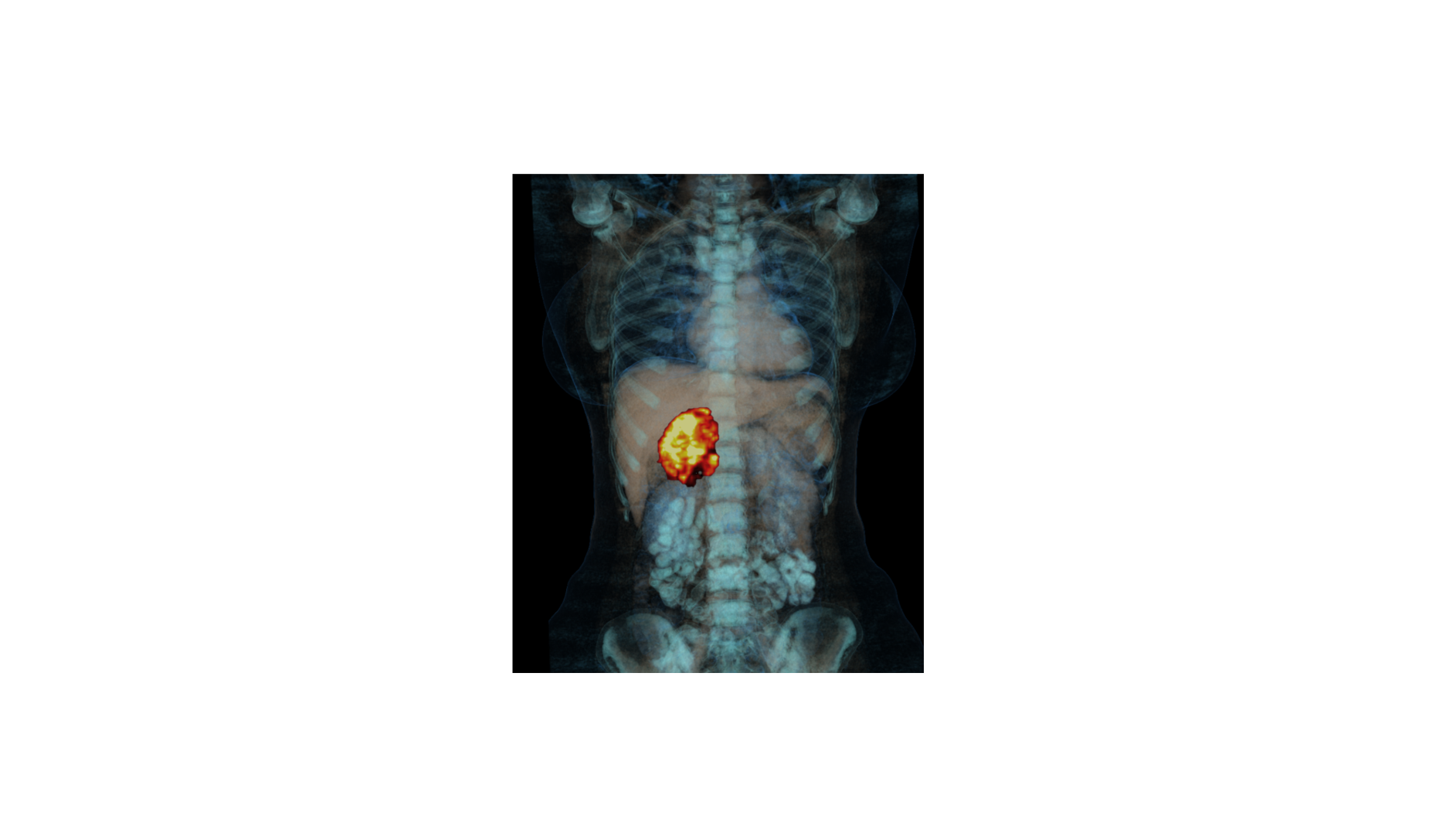 PET vom adrenocortical carcinoma (ACC)