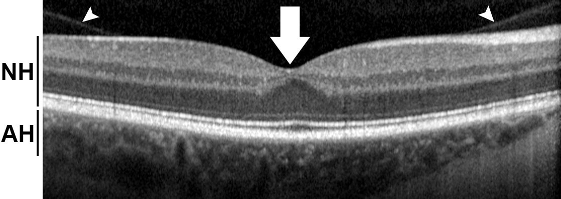 Optische Kohärenztomographie Röntgenbild: Optische Kohärenztomographie