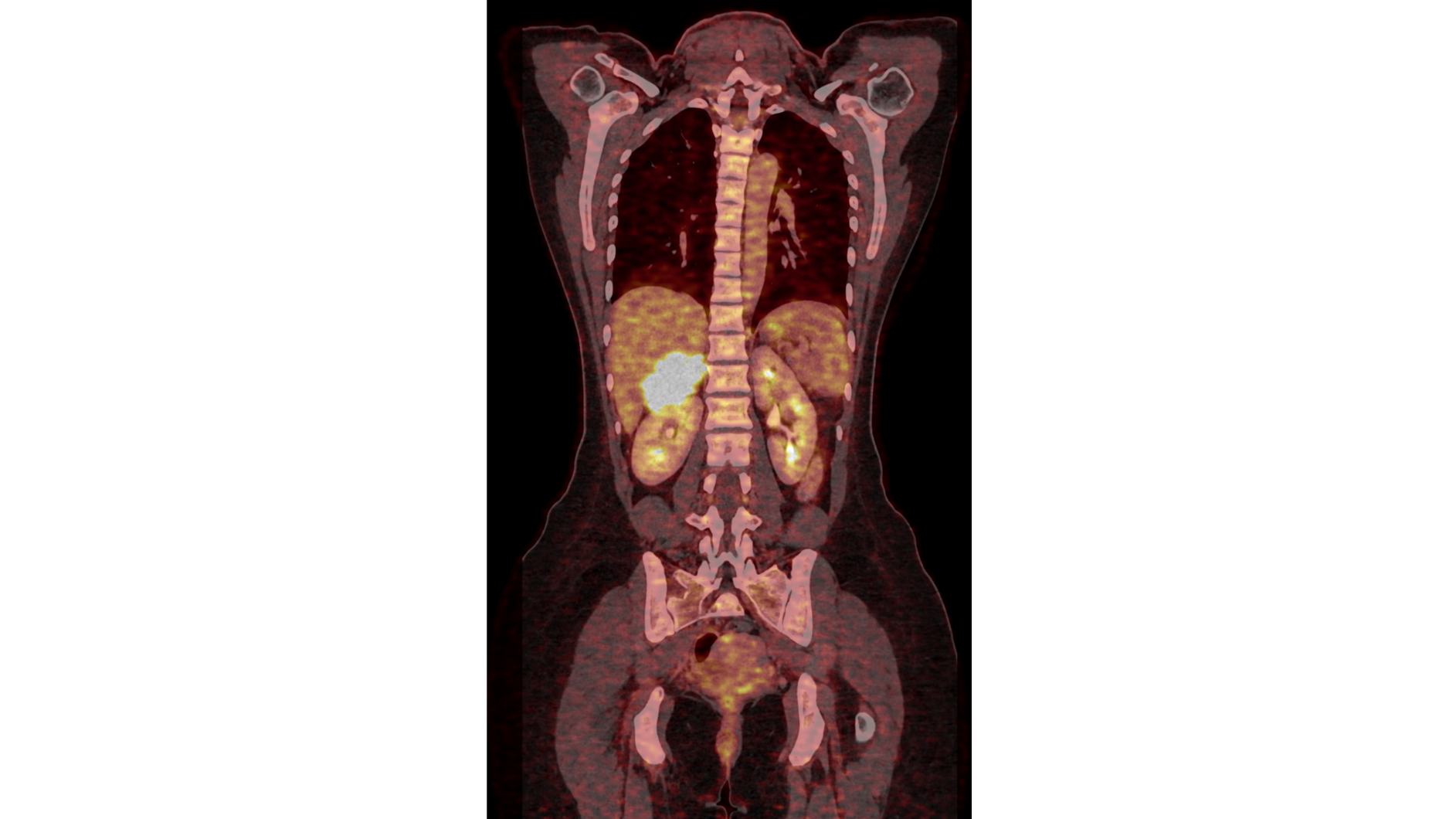 Positronen Emissions Tomografie (PET) adrenocortical carcinoma (ACC)