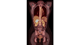 Positronen Emissions Tomografie (PET) adrenocortical carcinoma (ACC)