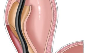 Illustrationsfoto: Der Muskel wird gespalten