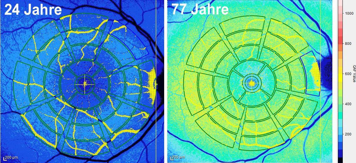 Abbildung einer quantitativen Fundus-Autofluoreszenz QAF