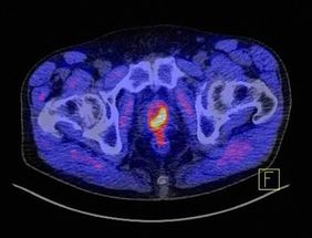 Der 6. Patienteninformationstag des Prostatakarzinomzentrums des Uniklinikums Würzburg am 8. Juni 2024 beschäftigt sich mit Vorsorge, Diagnostik und Therapie. Das Bild zeigt, wie markant ein Prostatakarzinom unter Zuhilfenahme des Tracers PSMA im PET-CT als gelb-rotes Objekt dargestellt wird.