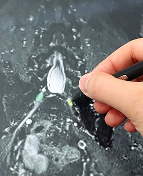 Eine Hand zeichnet mit einem Stift auf einer MRT-Aufnahme des lumbosakralen Rückenmarkssegments S1 die Spinalganglien grün und gelb ein. 