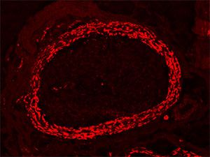 Immunhistochemie des Nervus suralis mit Expression von Claudin-1 (rot) im Perineurium Bild von Immunhistochemie des Nervus suralis mit Expression von Claudin-1 (rot) im Perineurium