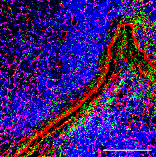 Tumorzellen, Immunzellen und stromale Zellen in einer Läsion des Multiplen Myeloms
