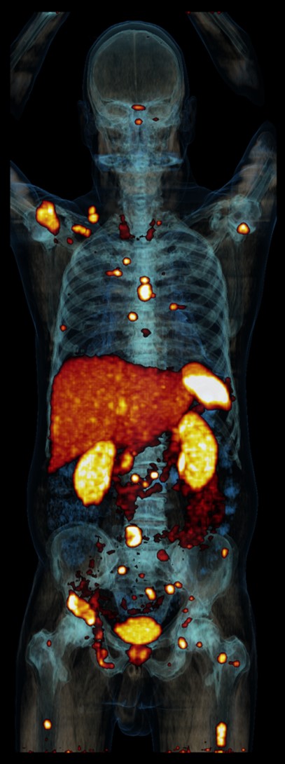 PET/CT-Aufnahme von metastasiertem Phäochromozytom Die PET/CT-Aufnahme zeigt Anreicherung des Tracers