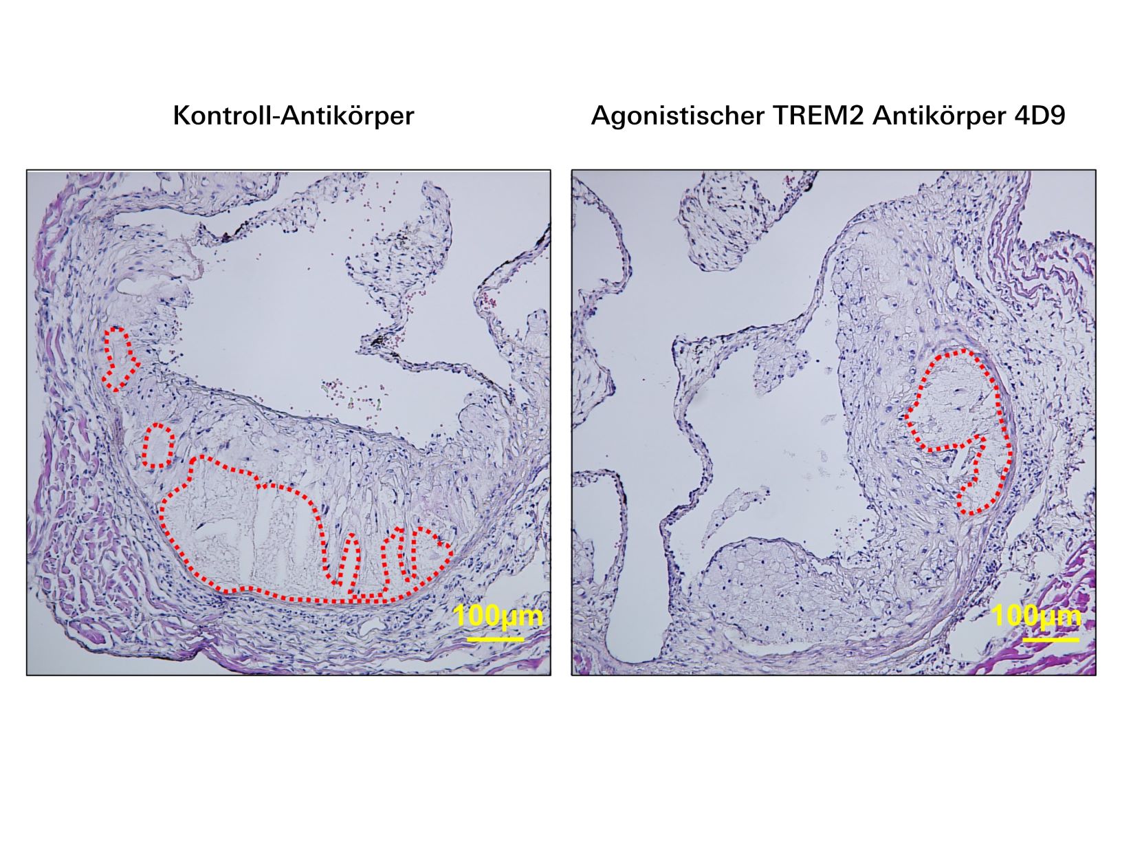 TREM2 Atherosklerose Agonistischer TREM2-Antikörper mit atheroprotektiver Funktion
