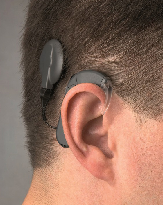 Im Jahr 1984 wurde das erste Cochlea-Implantat in Deutschland an der Medizinischen Hochschule Hannover implantiert. Heute sind bundesweit etwa 60.000 Menschen mit dieser Hörprothese versorgt. Bild: Helmut Korda / UKW Bild: Helmut Korda / UKW