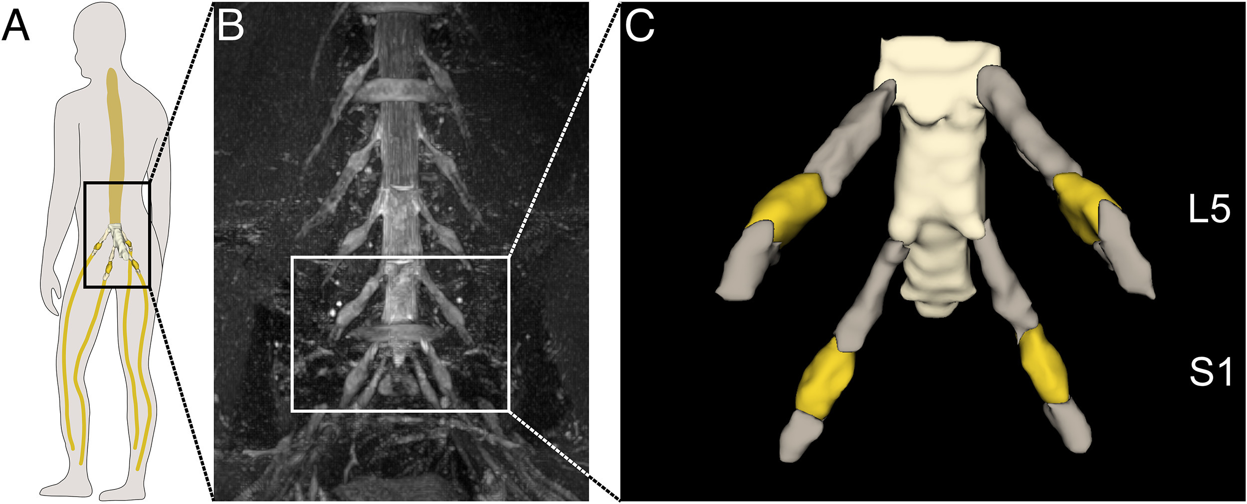 Anatomische Übersicht der lumbosakralen Spinalganglien Die Grafik zeigt auf drei Bildern, wo die lumbosakralen Spinalganglien liegen und wie sie aussehen.