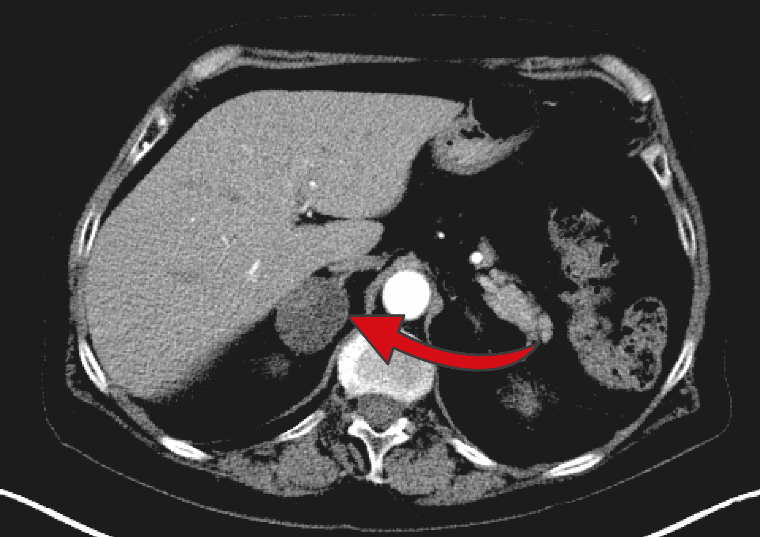 Nebennierentumor MRT-Aufnahme eines Nebennierentumors - ein roter Pfeil zeigt auf den Tumor